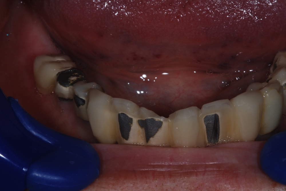 Implantátumos alsó hibrid körhíd also