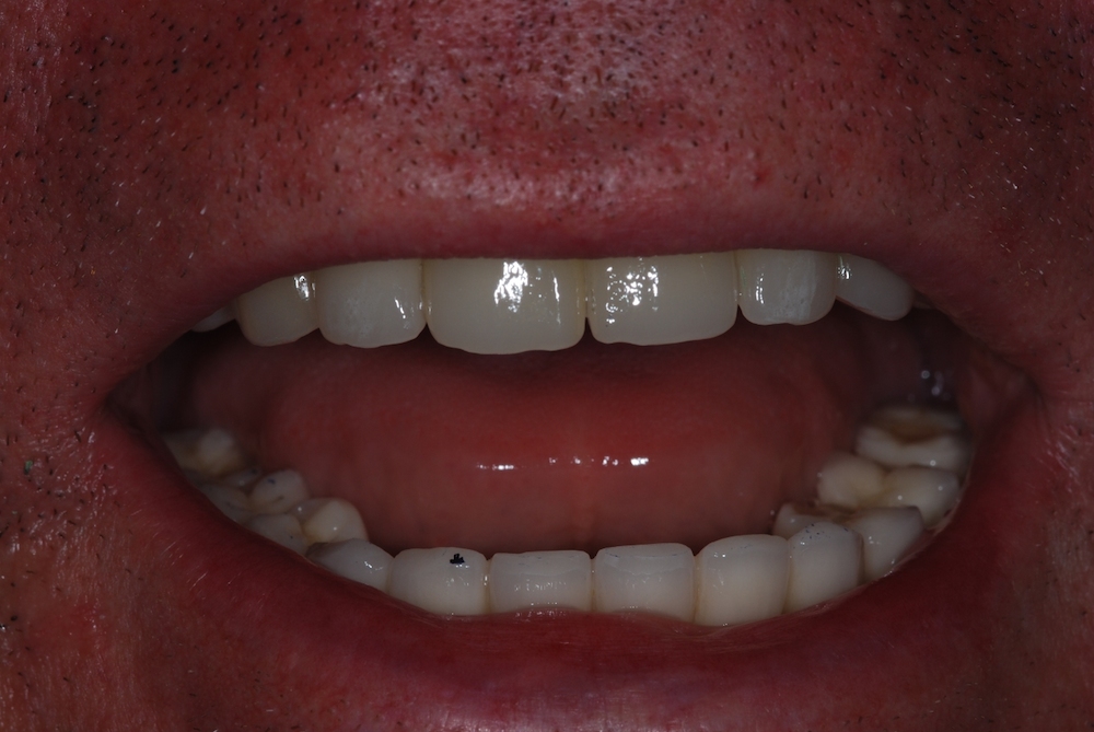 Felső hibrid híd 6 implantátumon hibrid-hid