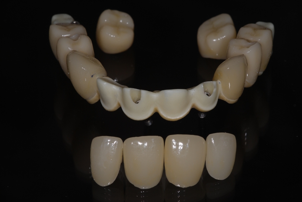 Felső hibrid híd 6 implantátumon hibrid-hid2