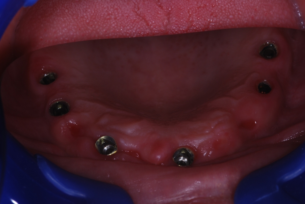 Felső hibrid híd 6 implantátumon hibrid-hid2