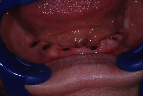 6db alsó Nobel implantátum 3 hónap gyógyulás után eset02a_n