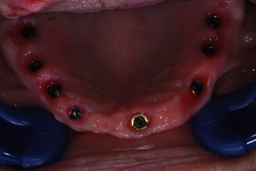 8 db felső Nobel Groovy implantátum eset02b_n