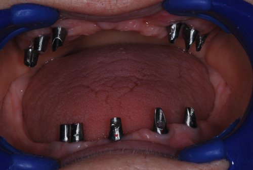A csontpótlások után 9 hónappal a 11 db Zimmer implantátum eset08a_n