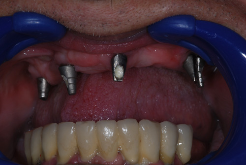 2008-ban, fogkőeltávolítás előtt az alsó implantátumos híd - már készül az új felső híd eset09a_n