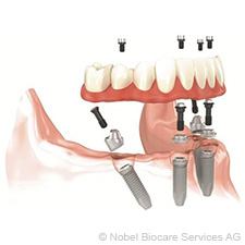 All-on-4: loss of teeth with 4 implants, without bone replacement all-on-4-loss-of-teeth-with-4-implants-without-bone-replacement-small