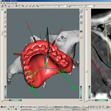 Implantation without surgery: NobelGuide implantation-without surgery-nobelguide-small