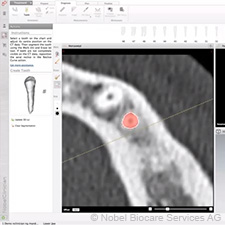 NobelGuide CAD – making a plan nobelguide-cad-making-a-plan