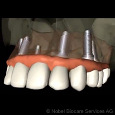 NobelGuide – complete loss of teeth with immediate restoration nobelguide-complete-loss-of-teeth-with-immediate-restoration