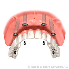 Screw-retained All-on-4 bridge screw-retained-all-on-4-bridge-small