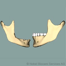 Atrofie celé čelisti a nezbytná péče vyžadují speciální znalosti the-atrophy-of-the-entire-jaw-and-its-care-need-special-knowledge